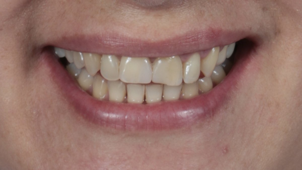 Antes: Diseño de sonrisa con carillas dentales
