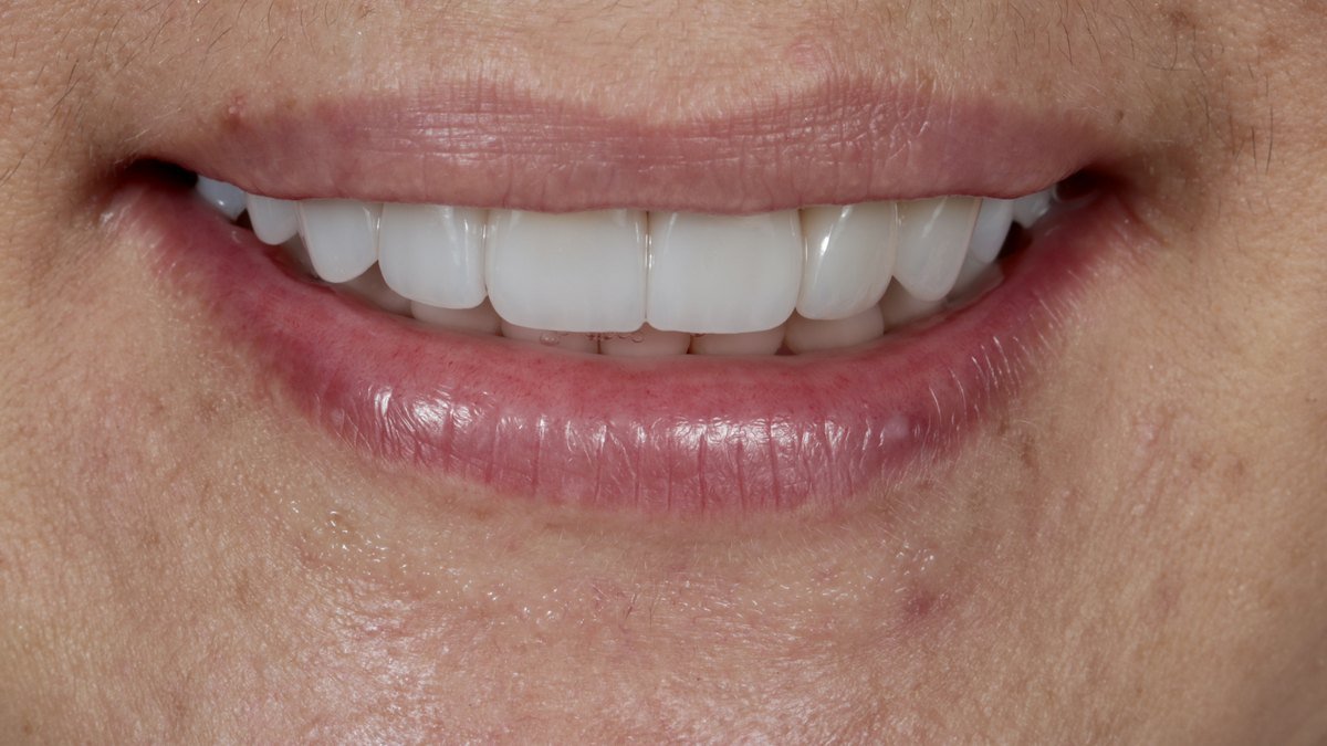 Diseño de sonrisa con carillas dentales