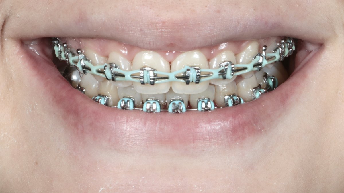 Con aparatología fija: Corrección de mordida Clase II con mini-implantes de anclaje