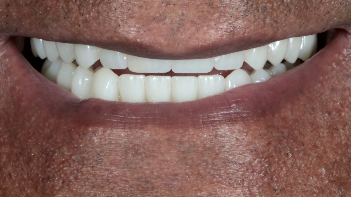Rehabilitación full arch con implantes dentales