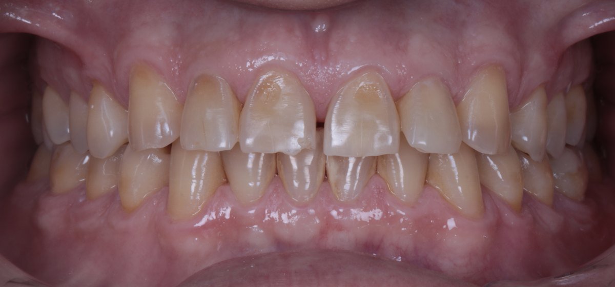 Before: Oral rehabilitation with injected composite