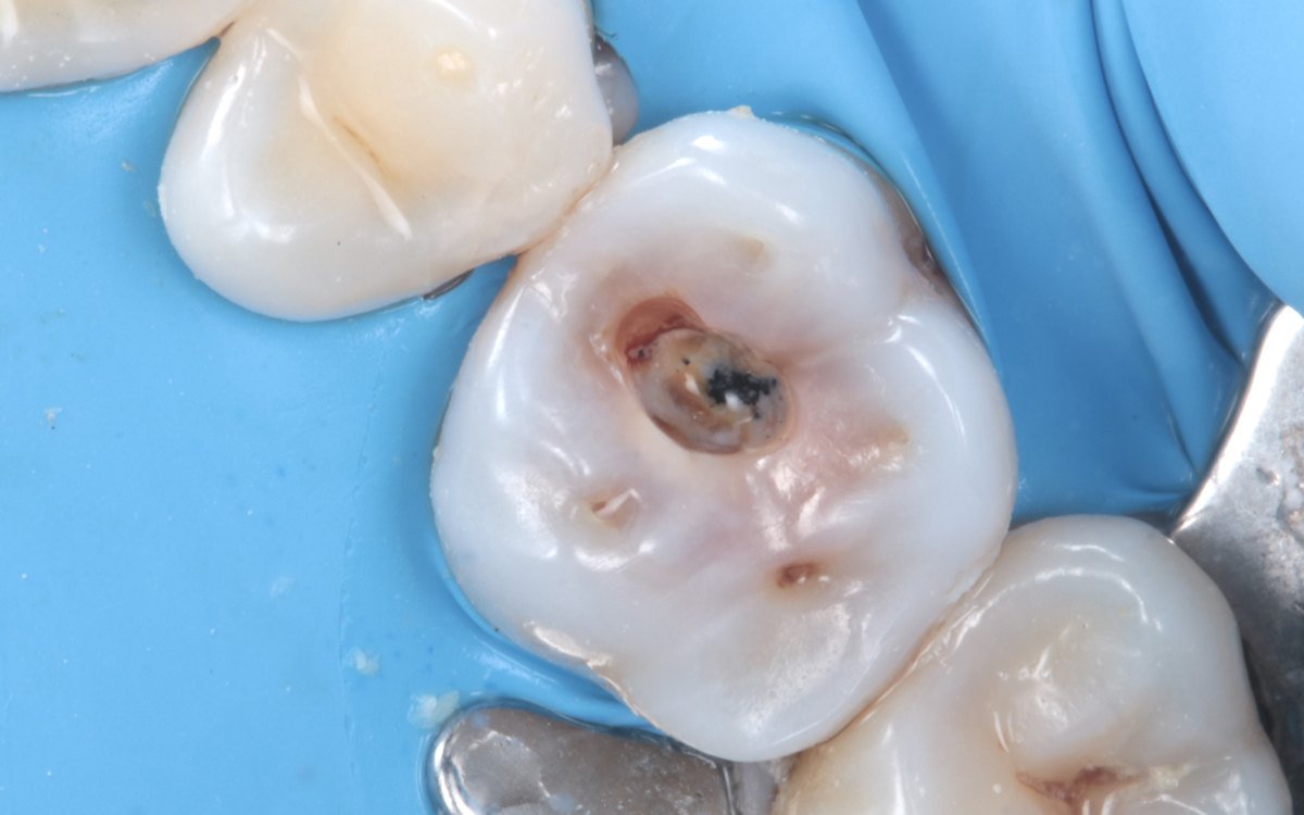 The decay, before removal: Composite restoration of an upper molar