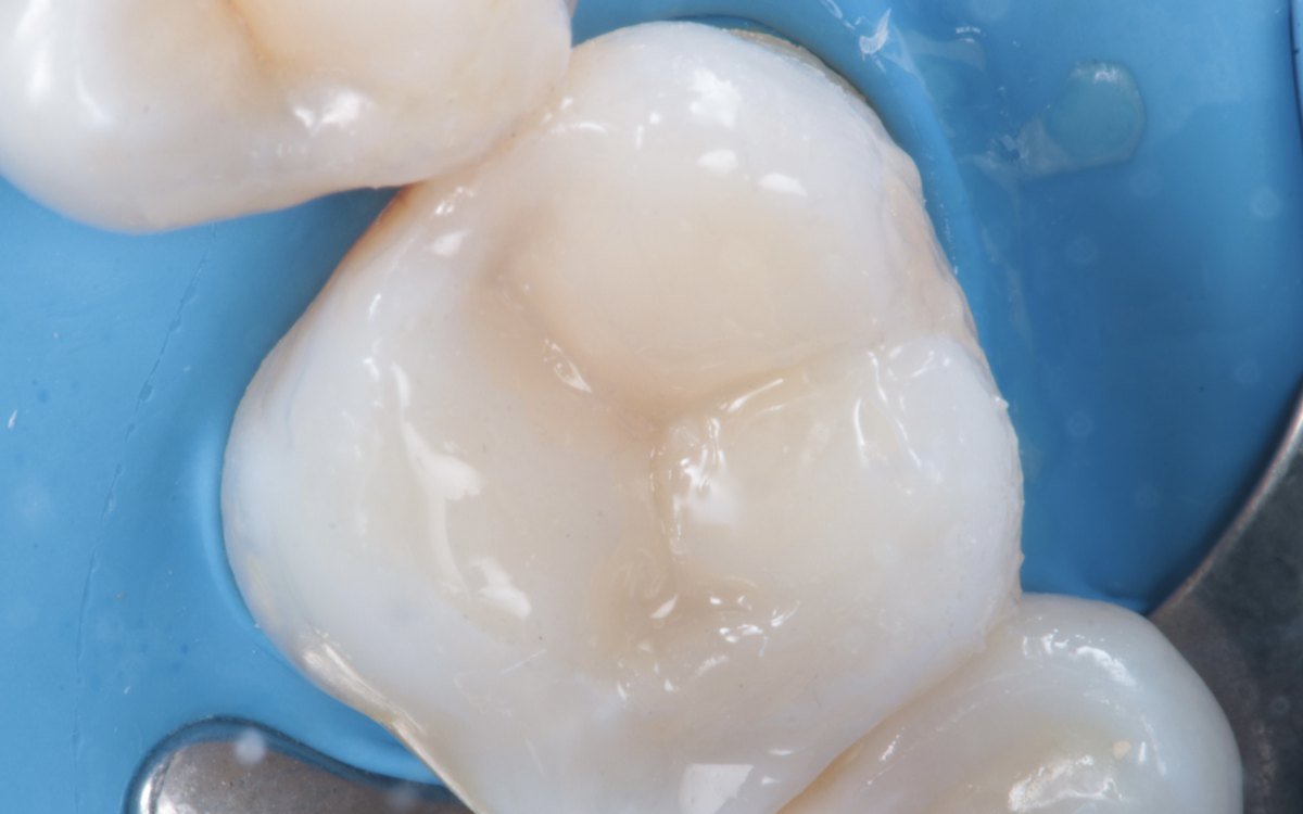 Restauración de un molar con resina compuesta